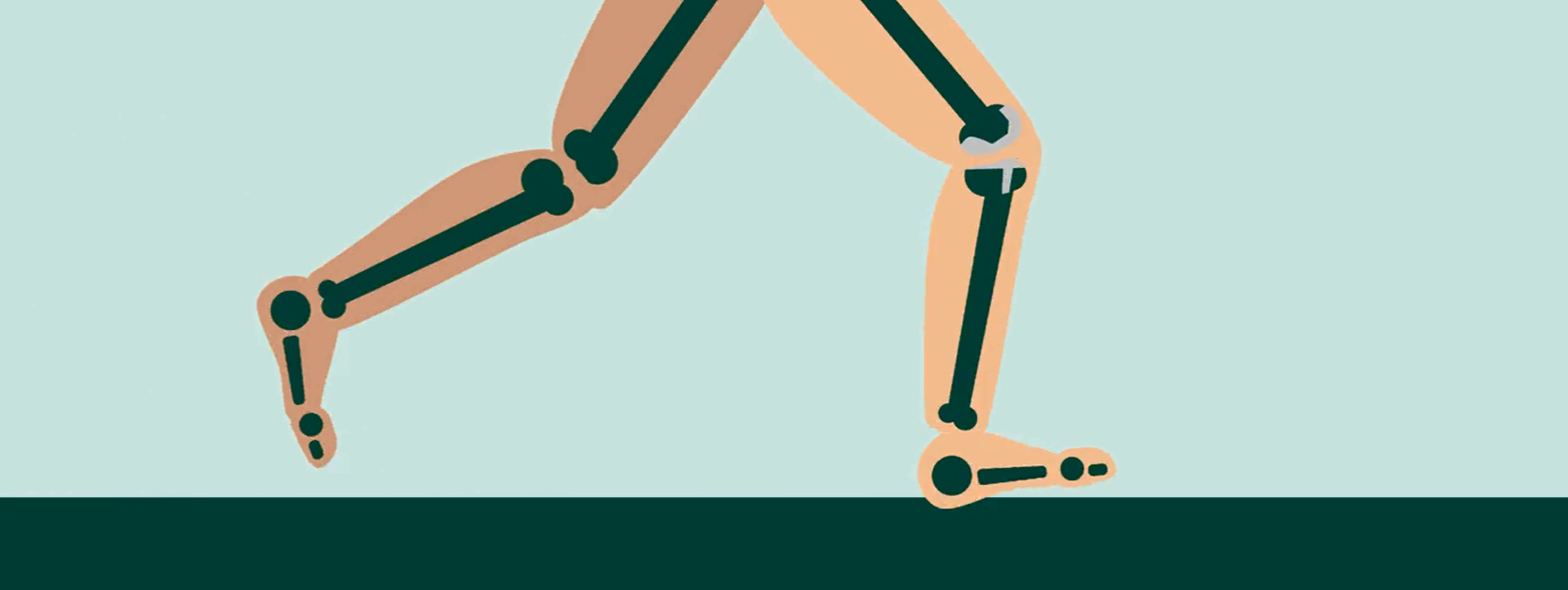 Hoegaathetmetuwknieprothese 1